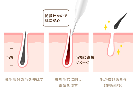 針脱毛イラスト