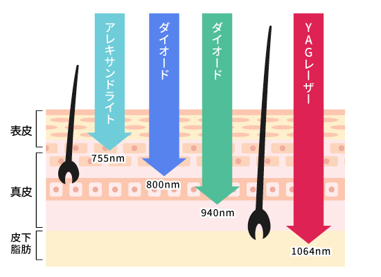 医療脱毛に使われる各レーザーの特徴