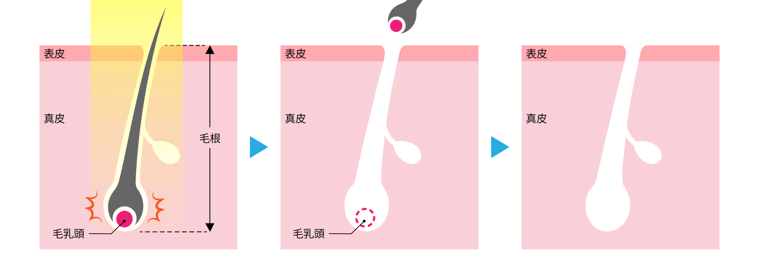 医療脱毛イメージ