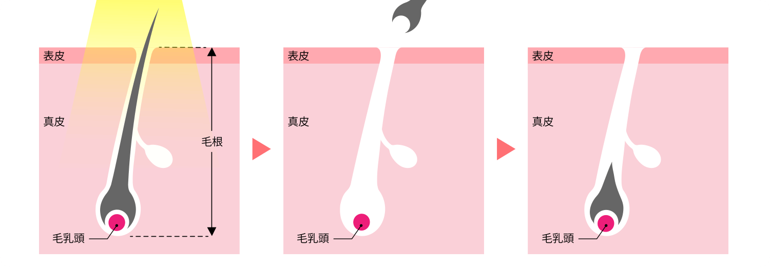 エステ脱毛（蓄熱式）イメージ